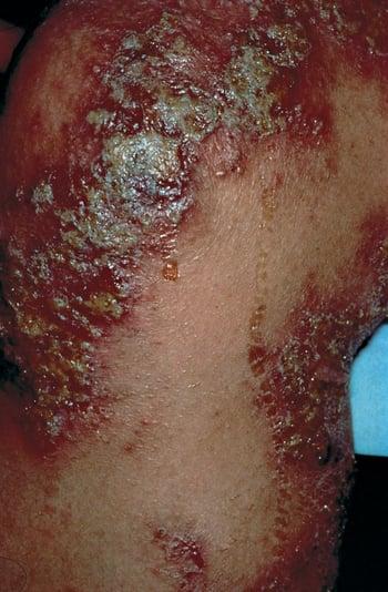 Dermatite atopique aiguë avec infection secondaire