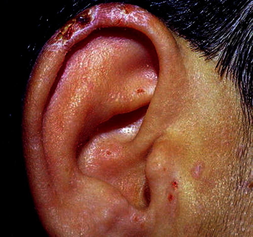 Porfiria cutánea tardía (lóbulo de la oreja)