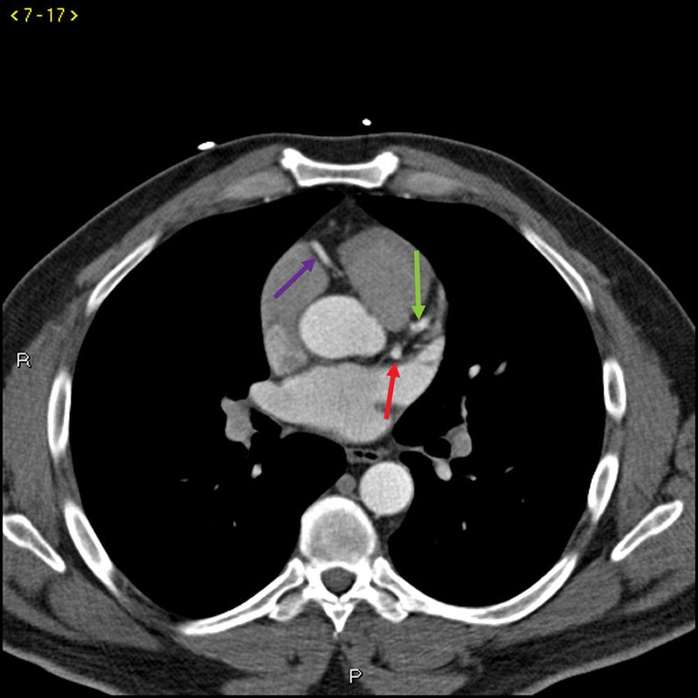 Tomografía computarizada con contraste que muestra arterias coronarias normales–diapositiva 2