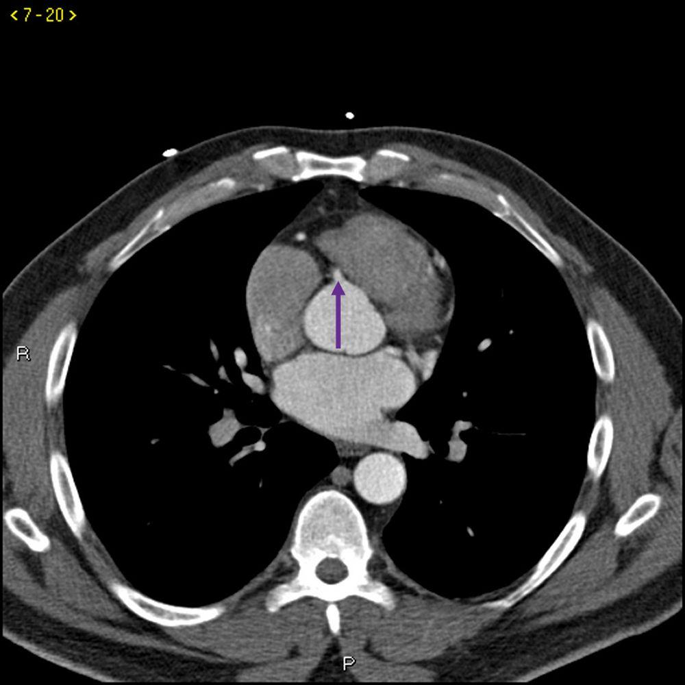 Tomografía computarizada con contraste que muestra arterias coronarias normales–diapositiva 5