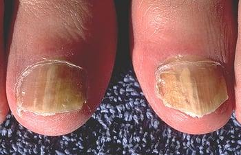 Onicomicosis de los dedos gordos del pie