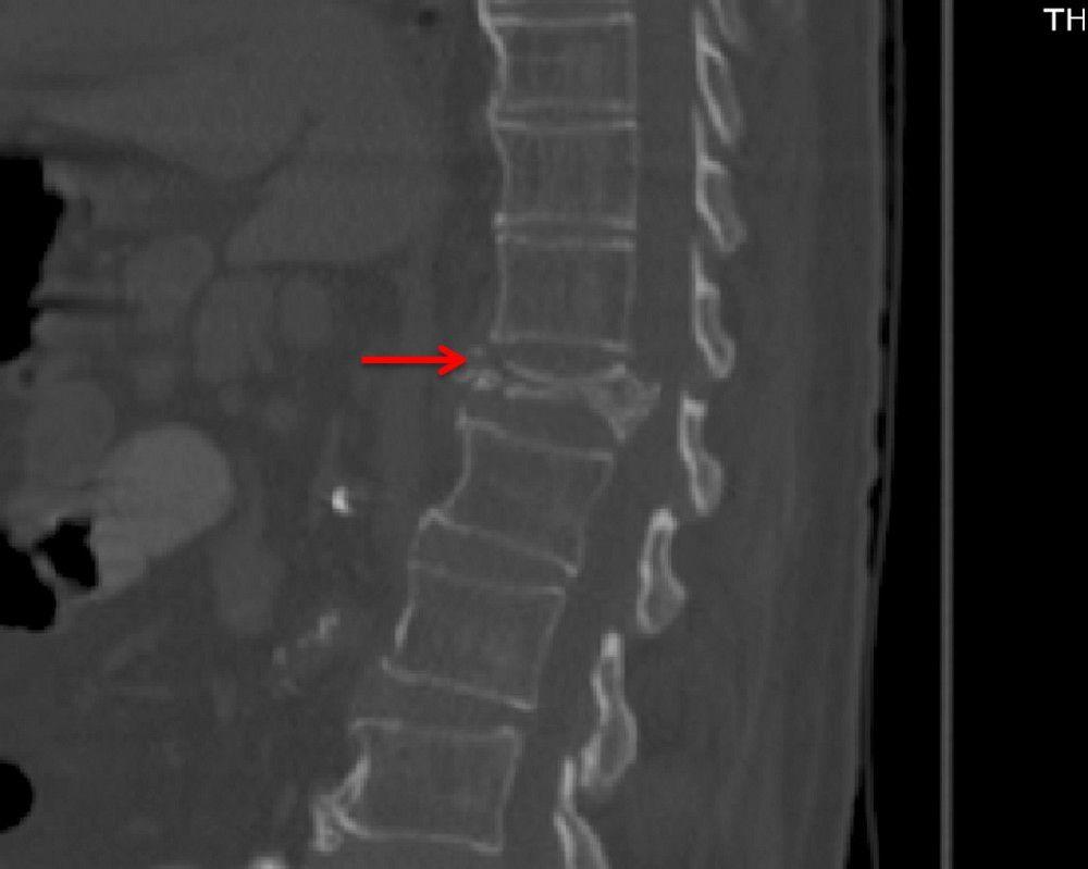 Severe Vertebral Compression Fracture (CT Scan)