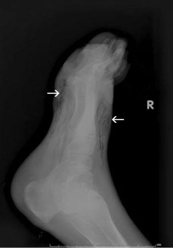 Gangrene of the Foot (X-Ray)