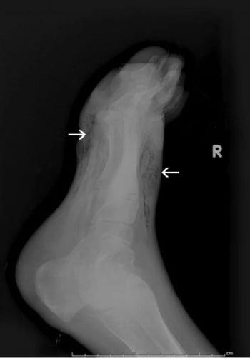 Gangrena del pie (radiografía)