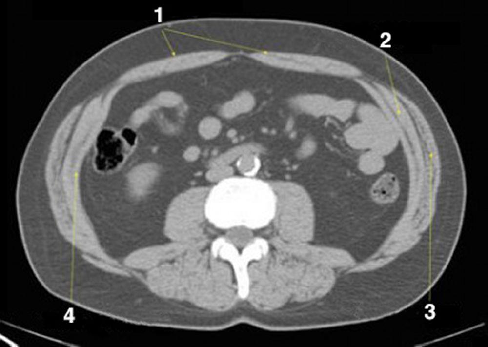 Tomografía computarizada sin contraste de abdomen y pelvis que muestra anatomía normal (corte 19)