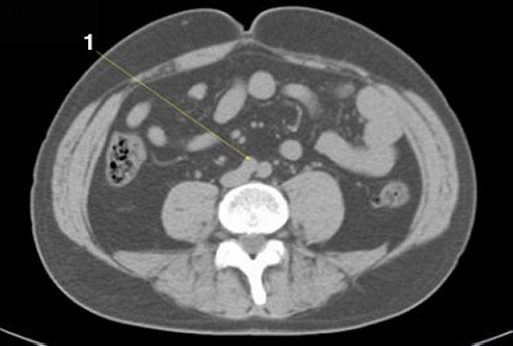 Tomografía computarizada sin contraste de abdomen y pelvis que muestra anatomía normal (corte 20)