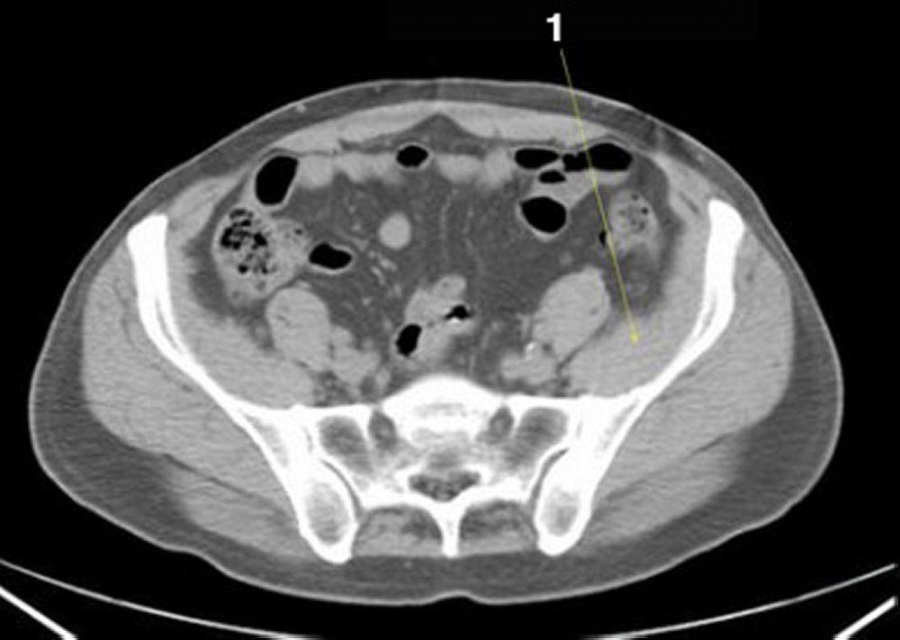 Tomografía computarizada sin contraste de abdomen y pelvis que muestra anatomía normal (corte 22)