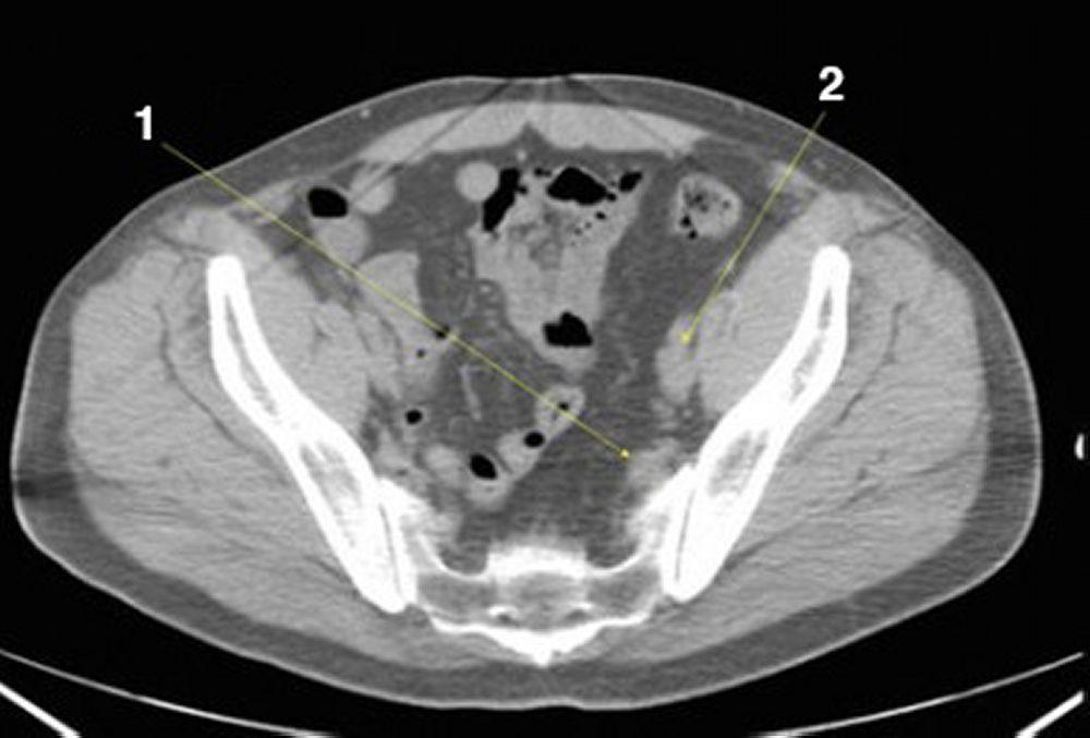 Tomografía computarizada sin contraste de abdomen y pelvis que muestra anatomía normal (corte 24)