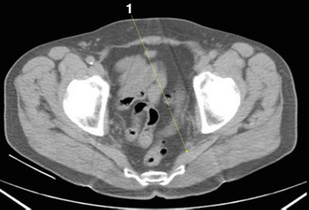 Tomografía computarizada sin contraste de abdomen y pelvis que muestra anatomía normal (corte 26)