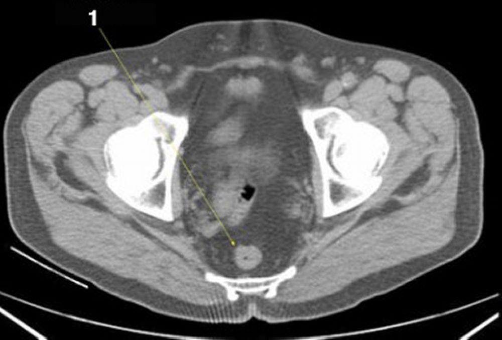 Tomografía computarizada sin contraste de abdomen y pelvis que muestra anatomía normal (corte 27)