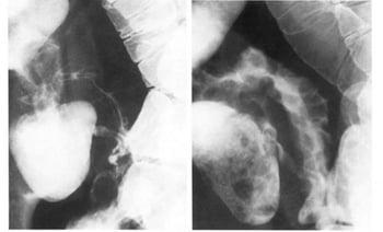 Transit de l'intestin grêle dans la maladie de Crohn montrant une sténose serrée