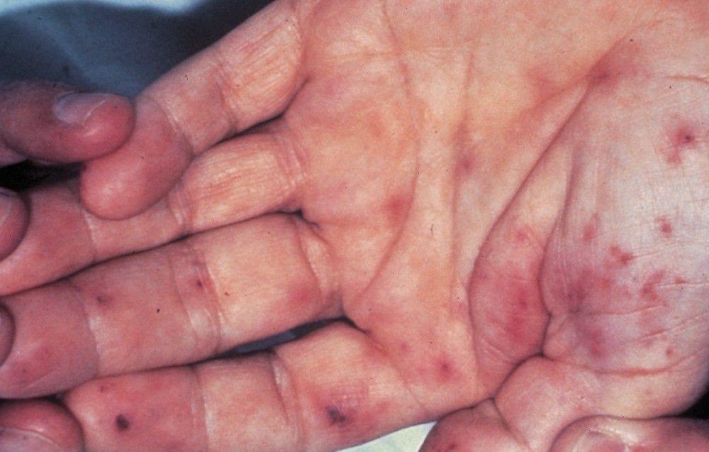 Infective Endocarditis (Janeway Lesions)