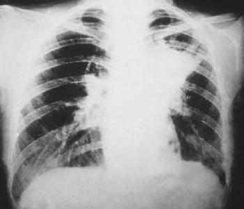 Blastomicosis pulmonar