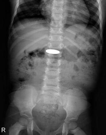 Cuerpo extraño en el tubo digestivo (radiografía)