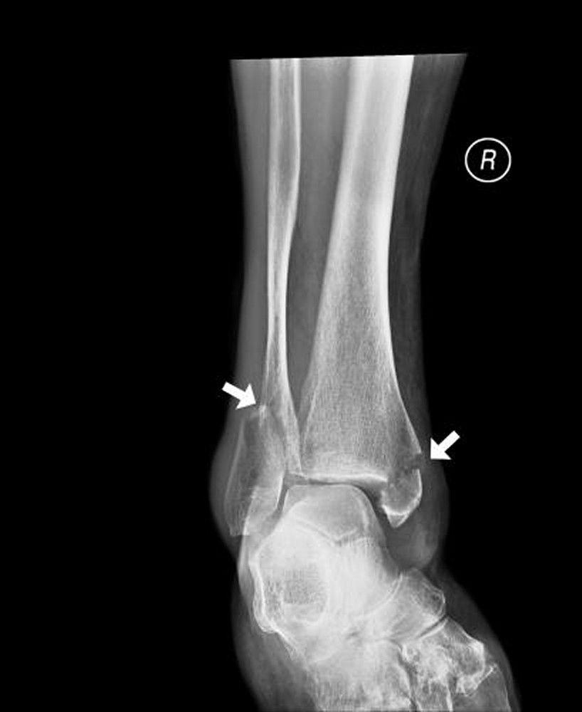 Ankle Fracture of Both Malleoli