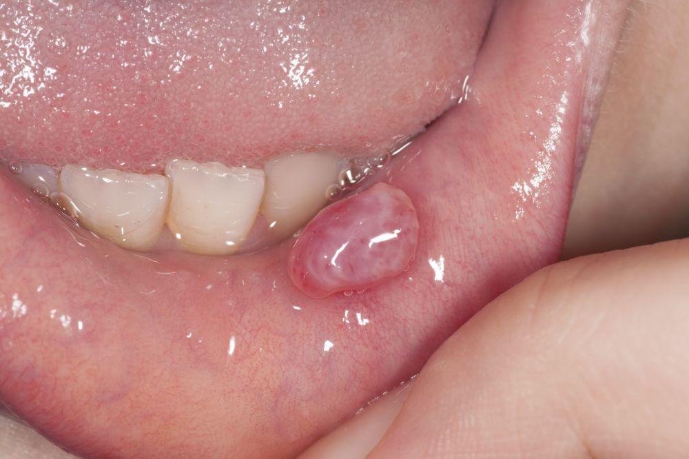 Kyste de rétention du mucus (mucocèle, phénomène d'extravasation du mucus)