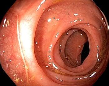Endoscopy (Large Intestine)