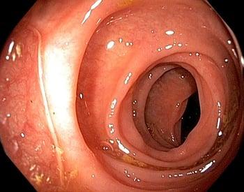 Endoscopia (intestino grueso)