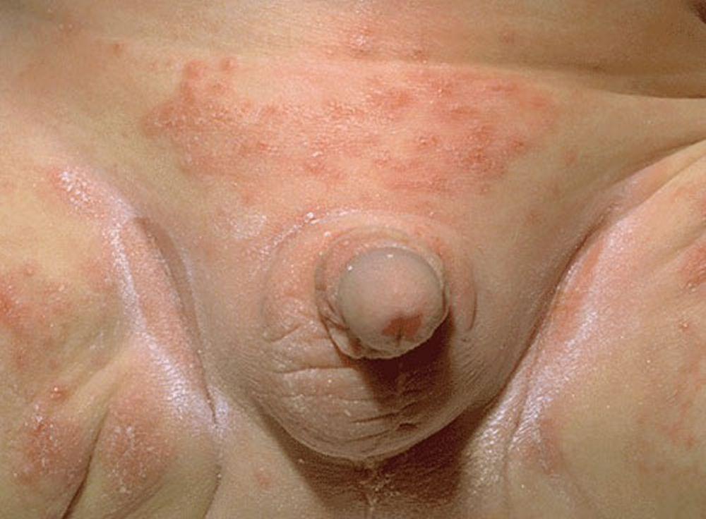 Candidiasis (dermatitis del pañal)