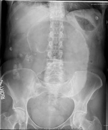 Vólvulo cecal (radiografía de abdomen)