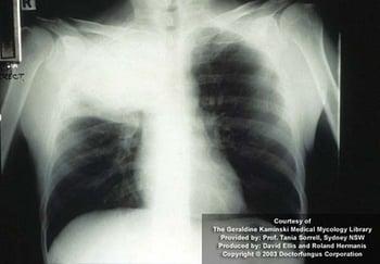 Criptococosis (pulmonar)