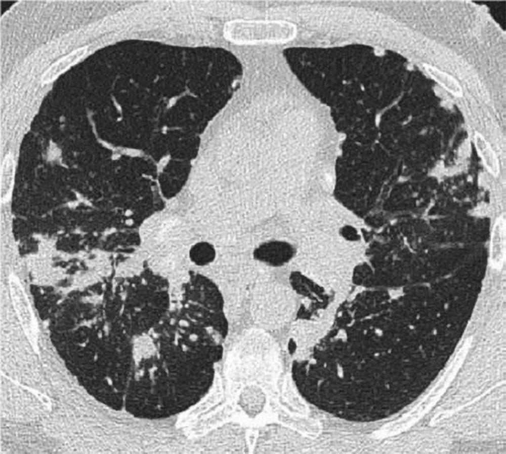 TDM thoracique d'une sarcoïdose pulmonaire