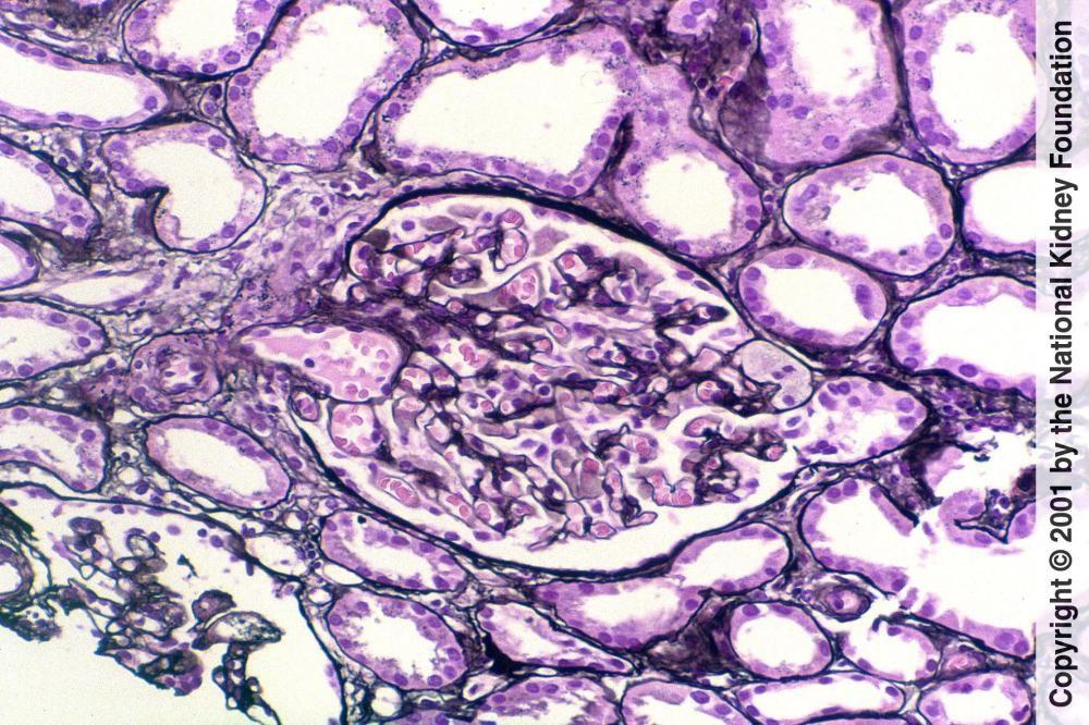 Glomérulosclérose segmentaire et focale
