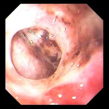 Perforación de úlcera gástrica