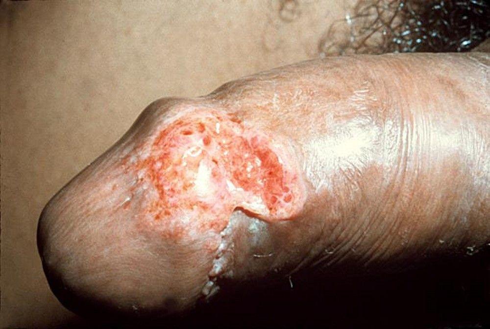 Granuloma Inguinale (Male)