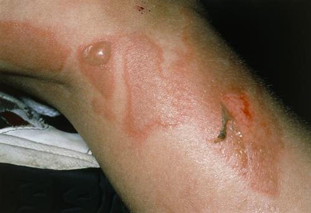 Syndrome d'épidermolyse staphylococcique (jambe)