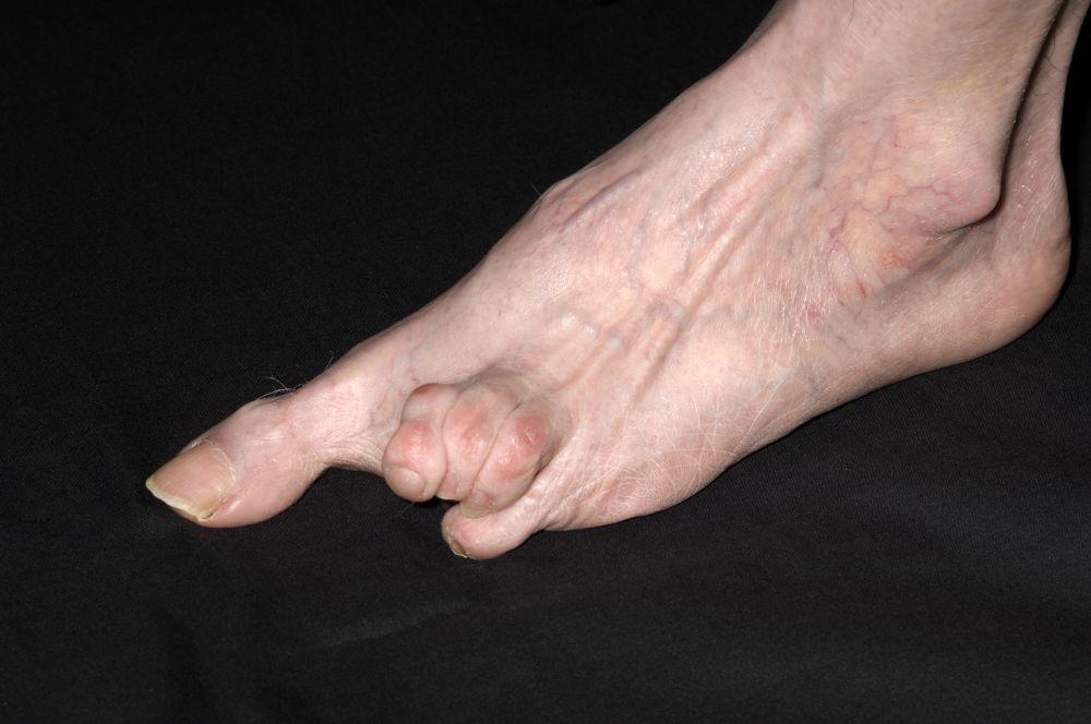 Sclérodermie systémique du pied