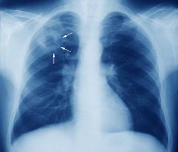 Tuberculose (rx thorax)