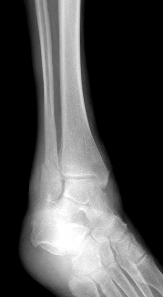 Fracture of Lateral Malleolus