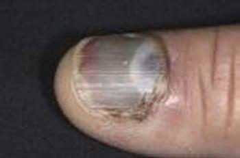 Hématome sous-unguéal (ongle)