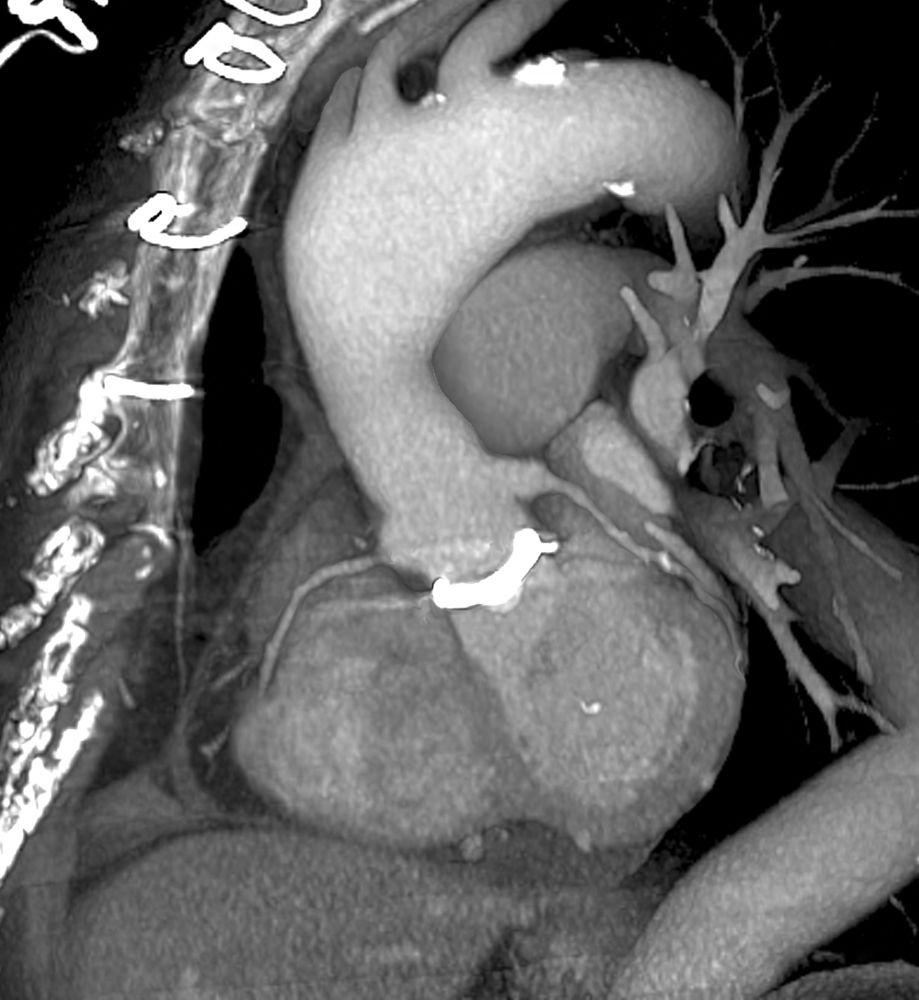 TC cardíaca (exploración 3D de la válvula cardíaca protésica)