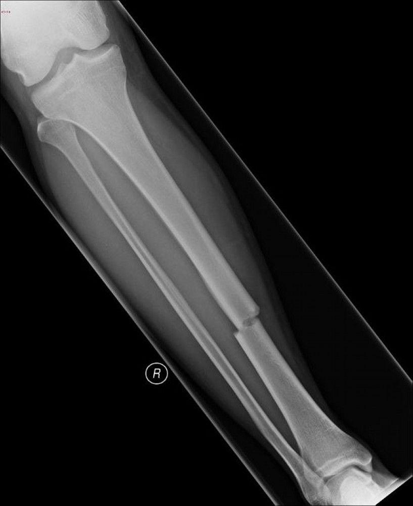 Transverse Fracture of the Tibial Shaft
