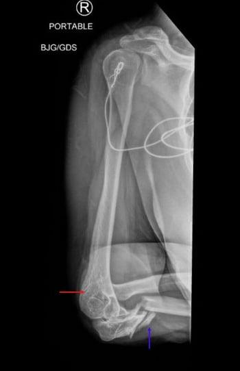 Monteggia Fracture Dislocation (1)