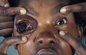 Melanoma of the Eye