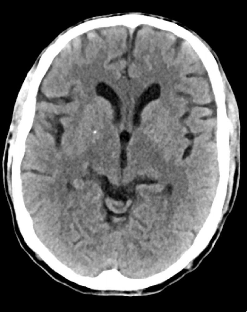 Normal Head CT Scan (Adult, Age 74) – Slide 6