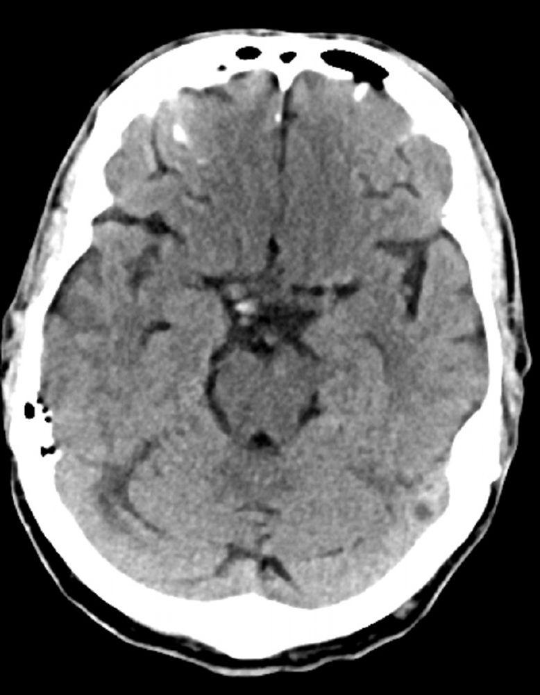 Normal Head CT Scan (Adult, Age 74) – Slide 7