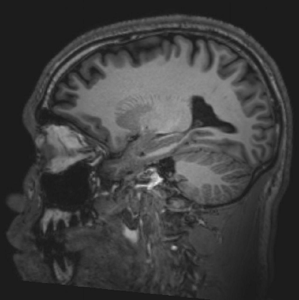 IRM cérébrale normale (sagittale) – Diapositive 2