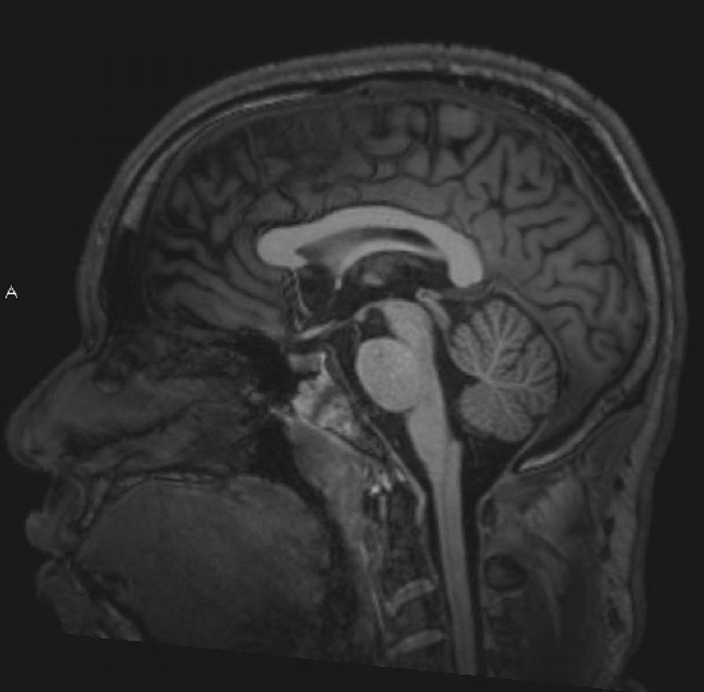 IRM cérébrale normale (sagittale) – Diapositive 4