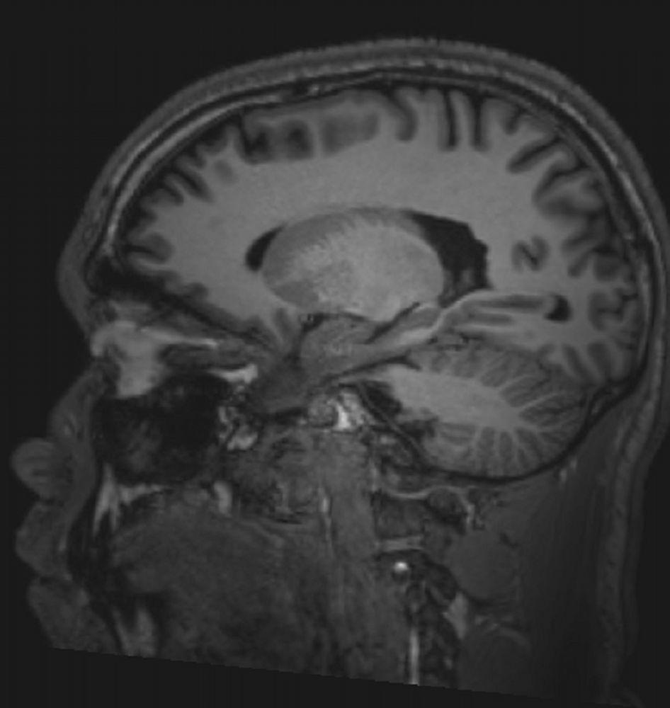 IRM cérébrale normale (sagittale) – Diapositive 5