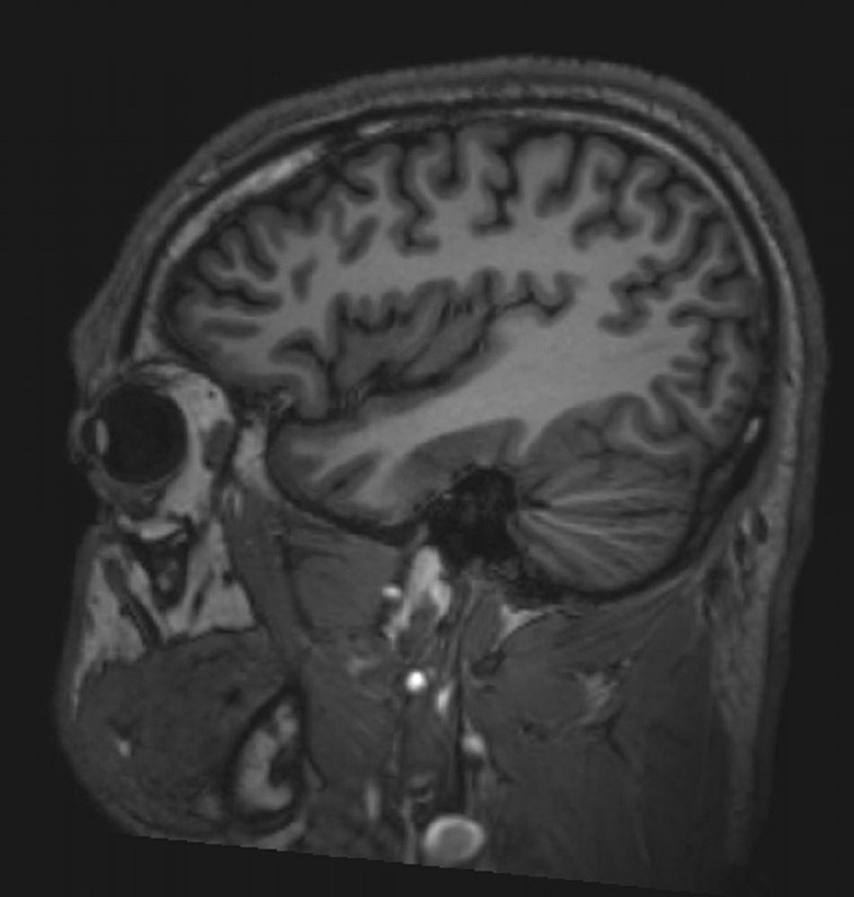 IRM cérébrale normale (sagittale) – Diapositive 6