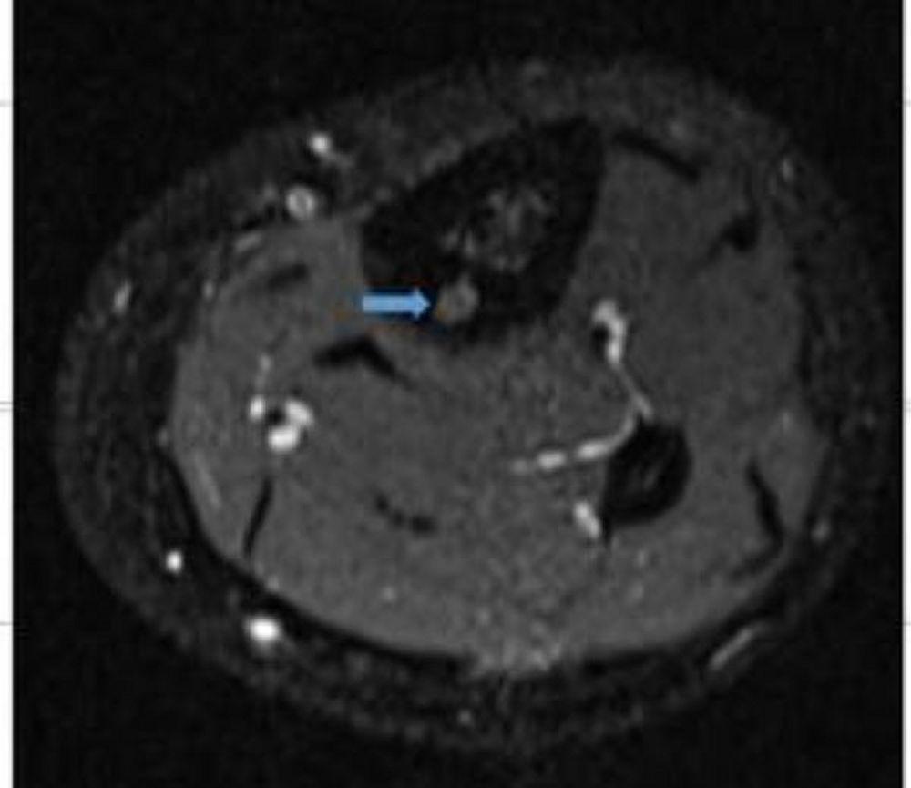 Ostéome ostéoïde du tibia (IRM)