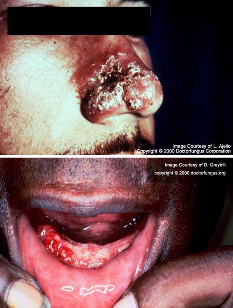 Paracoccidioïdomycose (ulcères cutanéomuqueux)