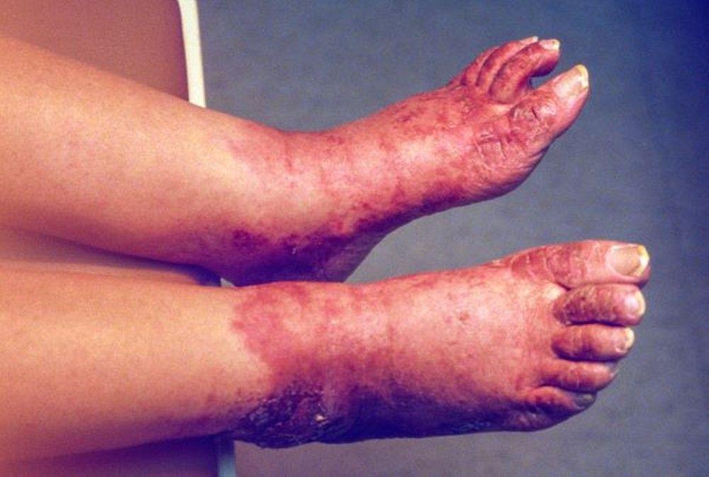 Pellagrous Skin Changes (Feet)