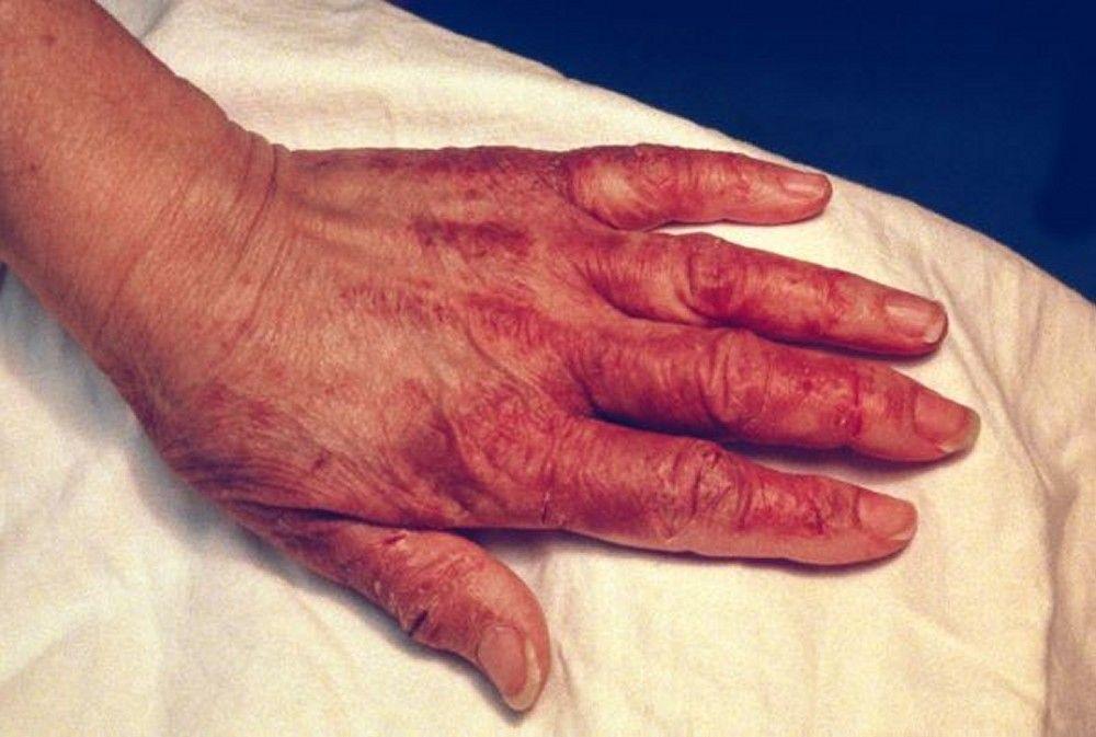 Pellagrous Skin Changes (Hand)