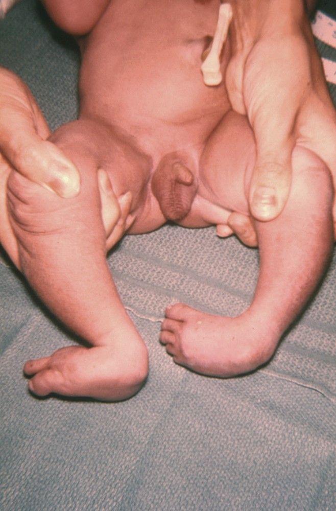 Rocker-Bottom Feet in Trisomy 18