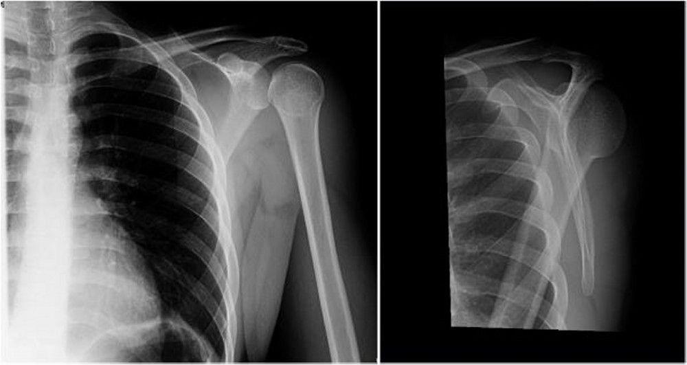 Posterior Shoulder Dislocation: Anteroposterior and Y Views
